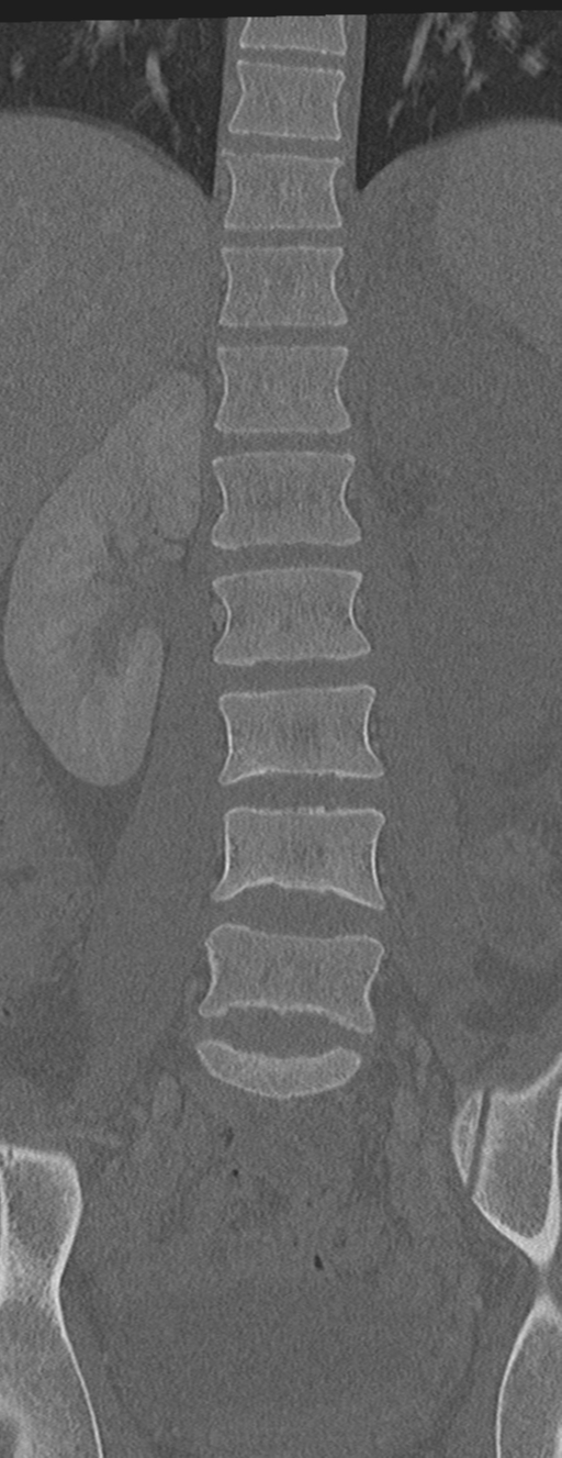 Abdominal multi-trauma - devascularised kidney and liver, spleen and pancreatic lacerations (Radiopaedia 34984-36486 Coronal bone window 29).png