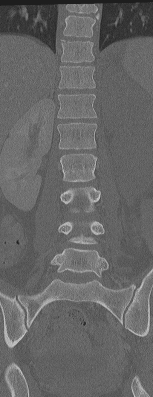 Abdominal multi-trauma - devascularised kidney and liver, spleen and pancreatic lacerations (Radiopaedia 34984-36486 Coronal bone window 35).png