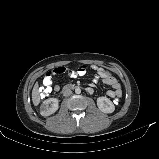 Abdominal multiorgan trauma (Radiopaedia 21792-21754 Axial C+ portal venous phase 24).jpg