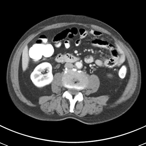Abdominal wall metastasis from colorectal carcinoma (Radiopaedia 31016-31717 Axial C+ portal venous phase 39).jpg