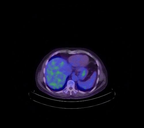 Abdominal wall metastasis from colorectal carcinoma (Radiopaedia 31016-31719 Axial 93).jpg