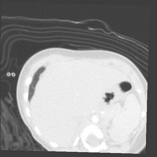 File:Aberrant left pulmonary artery (pulmonary sling) (Radiopaedia 42323-45435 Axial lung window 41).jpg