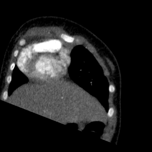 File:Aberrant left pulmonary artery (pulmonary sling) (Radiopaedia 42323-45435 Coronal C+ CTPA 22).jpg