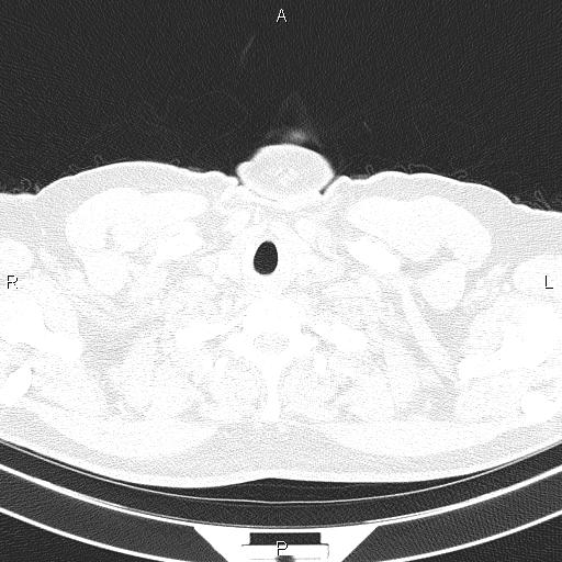 File:Aberrant right subclavian artery (Radiopaedia 87093-103354 Axial lung window 3).jpg