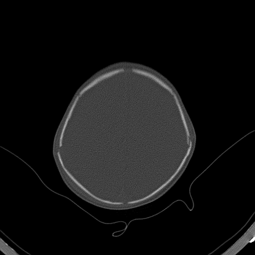 File:Accessory intraparietal suture (Radiopaedia 50584-56020 Axial bone window 35).jpg