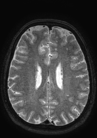 Accessory middle cerebral artery (Radiopaedia 73114-83828 Axial T2 16).jpg