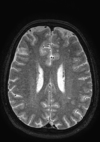 Accessory middle cerebral artery (Radiopaedia 73114-83828 Axial T2 17).jpg