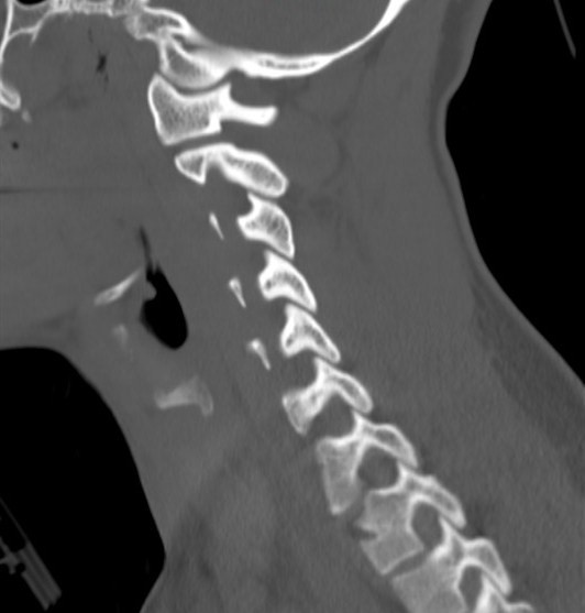 File:Accessory ossicle of the anterior arch of C1 vertebra (Radiopaedia 58149-65211 Sagittal bone window 14).jpg