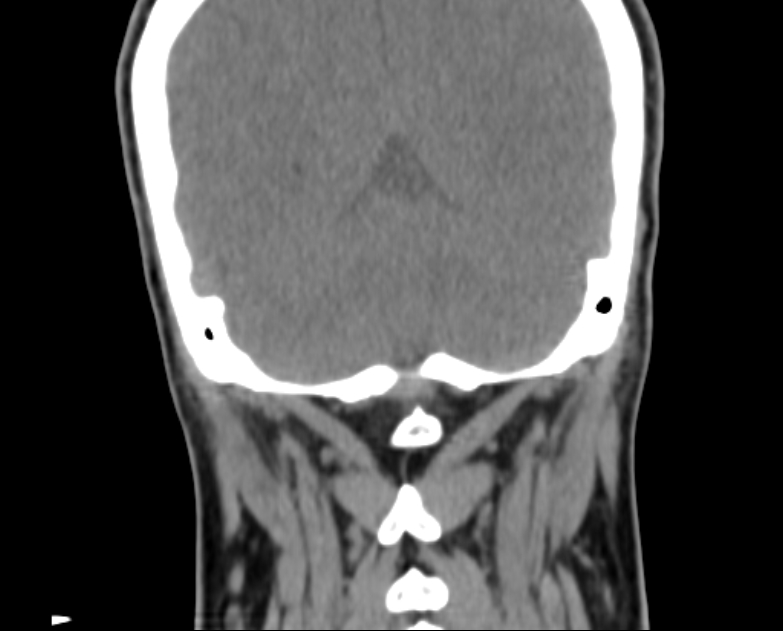 Accessory parotid gland (Radiopaedia 76207-87772 Coronal non-contrast 117).jpg