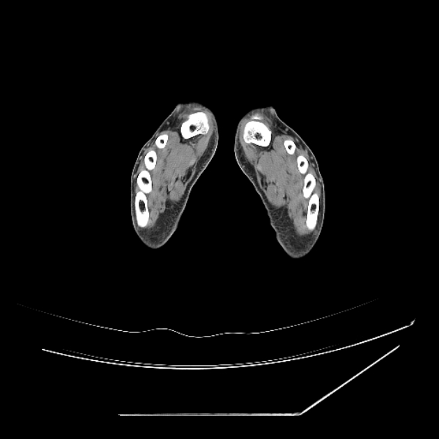 Accessory soleus muscle (Radiopaedia 61069-68943 Axial non-contrast 90).jpg