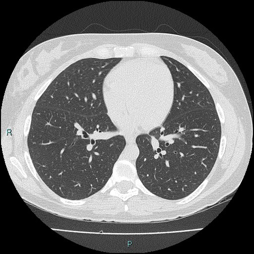 File:Accidental foreign body aspiration (seamstress needle) (Radiopaedia 77740-89983 Axial lung window 40).jpg