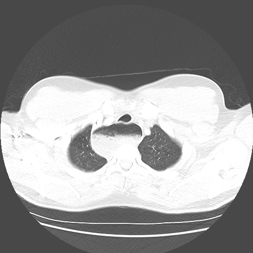 Achalasia (Radiopaedia 52507-58417 Axial lung window 9).jpg