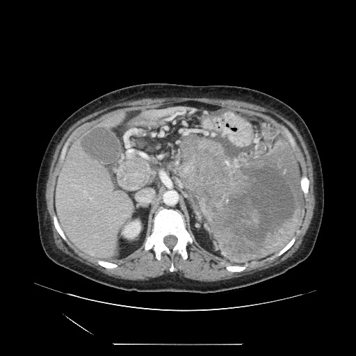 File:Acinar cell carcinoma of the pancreas (Radiopaedia 75442-86669 Axial C+ portal venous phase 43).jpg