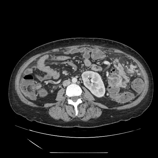 File:Acinar cell carcinoma of the pancreas (Radiopaedia 75442-86669 Axial C+ portal venous phase 79).jpg