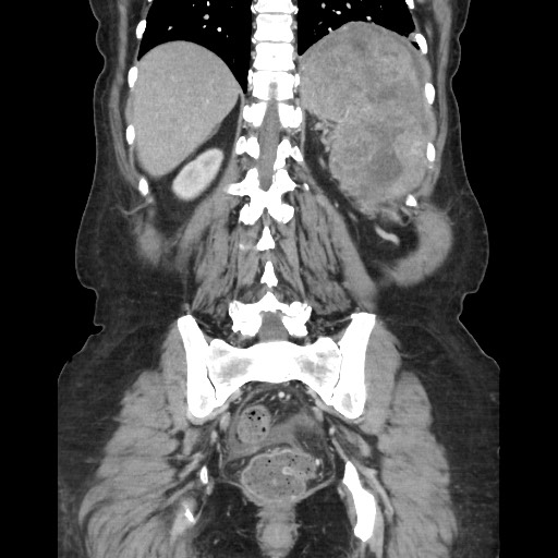 Acinar cell carcinoma of the pancreas (Radiopaedia 75442-86669 Coronal C+ portal venous phase 96).jpg