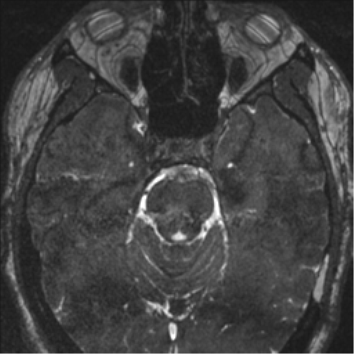 Acoustic schwannoma (translabyrinthine resection) (Radiopaedia 43570-46972 Axial CISS 52).png