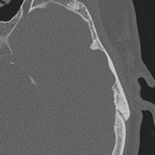 Acoustic schwannoma - cystic (Radiopaedia 29487-29980 AXIAL LEFT bone window 49).jpg