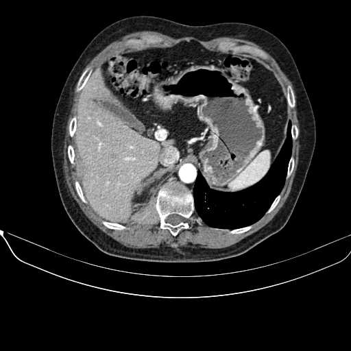 File:Acquired adrenal hyperplasia - due to thymic carcinoid tumor (Radiopaedia 21269-21184 C+ arterial phase 20).jpg