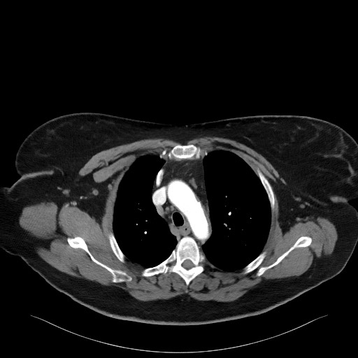 Acromioclavicular joint cyst (Radiopaedia 58455-65610 Axial C+ arterial phase 40).jpg
