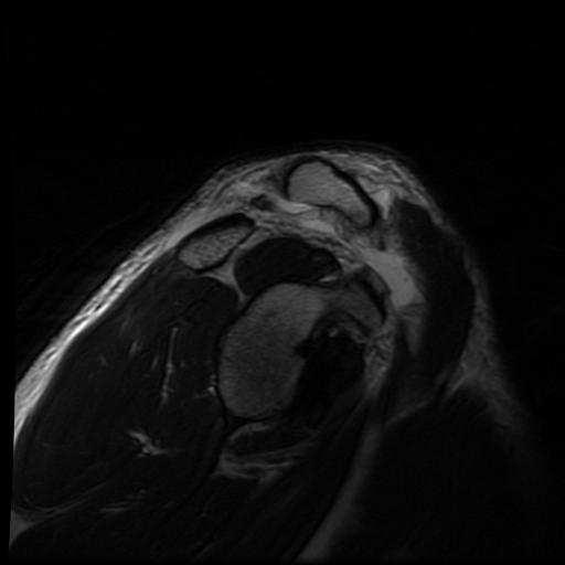 File:Acromioclavicular joint dislocation (Radiopaedia 14218-14076 Sagittal T2 9).jpg