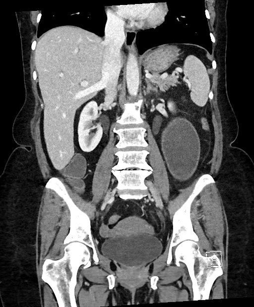Active Crohn disease (Radiopaedia 59394-66750 Coronal C+ portal venous phase 42).jpg
