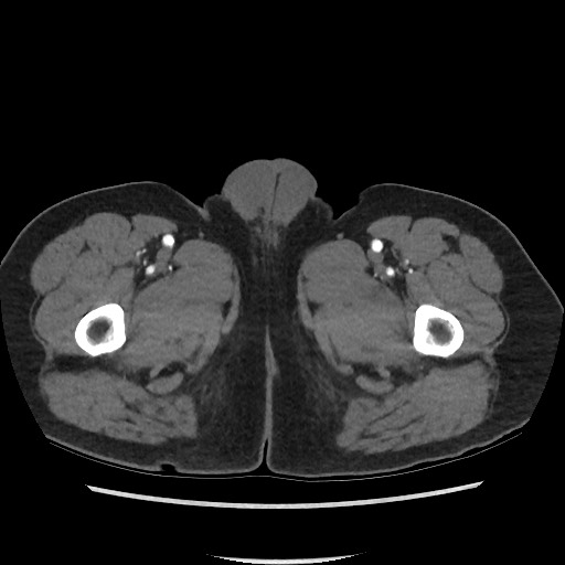 Active colonic bleed on CT (Radiopaedia 49765-55025 Axial C+ arterial phase 95).jpg