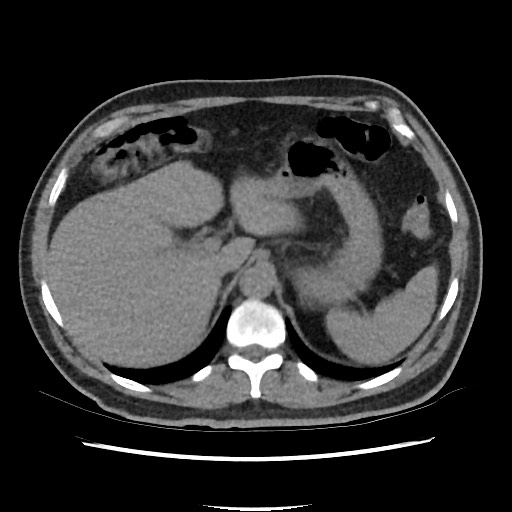 Active colonic bleed on CT (Radiopaedia 49765-55025 Axial non-contrast 16).jpg