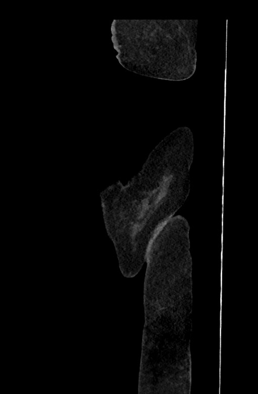 Active renal extravasation with large subcapsular and retroperitoneal hemorrhage (Radiopaedia 60975-68796 Sagittal C+ portal venous phase 223).jpg