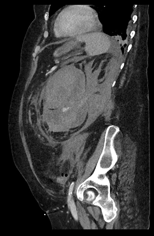 Active renal extravasation with large subcapsular and retroperitoneal hemorrhage (Radiopaedia 60975-68796 Sagittal C+ portal venous phase 78).jpg