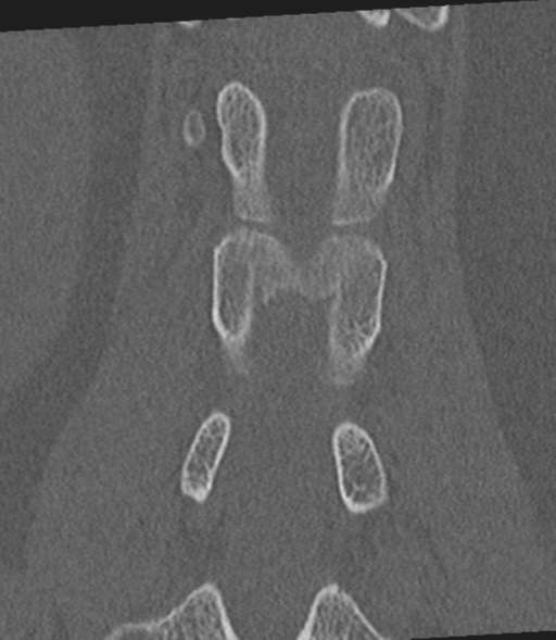 Acute L1 burst compression fracture (Radiopaedia 34430-35755 Coronal bone window 36).png