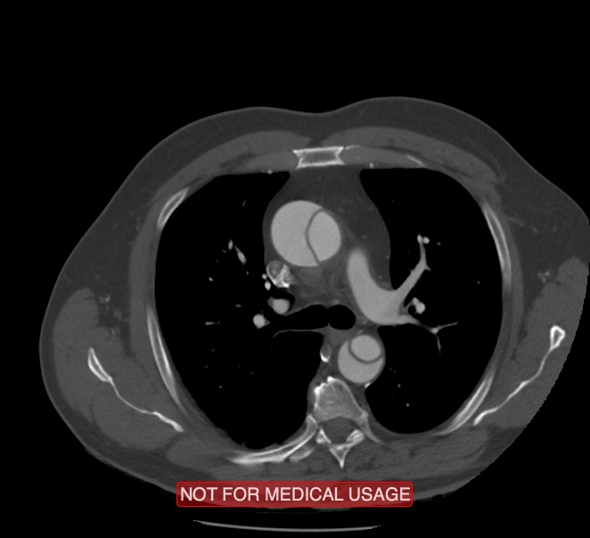 Acute aortic dissection - Stanford type A (Radiopaedia 40661-43285 Axial C+ arterial phase 18).jpg