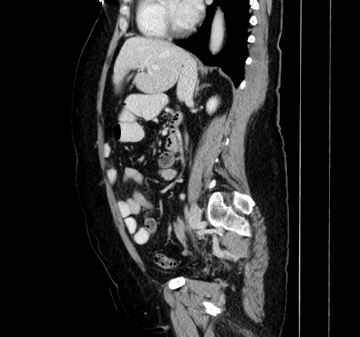 Acute appendicitis, heterotaxy syndrome (Radiopaedia 66884-76202 Sagittal C+ portal venous phase 82).jpg