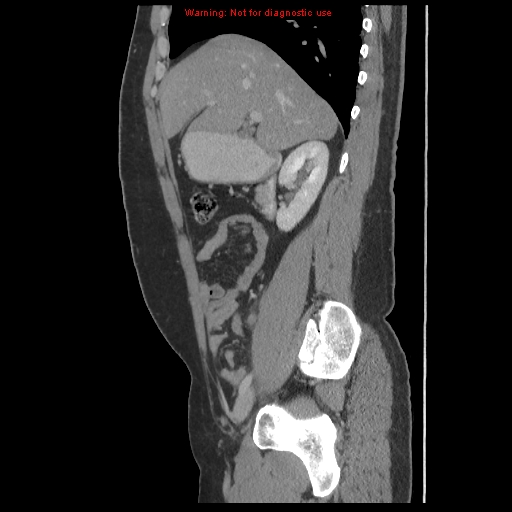 File:Acute appendicitis (Radiopaedia 10498-10973 Sagittal C+ portal venous phase 10).jpg