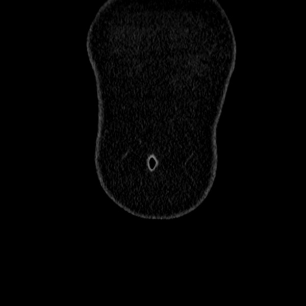 Acute appendicitis (Radiopaedia 38255-40270 Coronal C+ portal venous phase 5).jpg