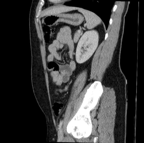 Acute appendicitis (Radiopaedia 38255-40270 Sagittal C+ portal venous phase 60).jpg