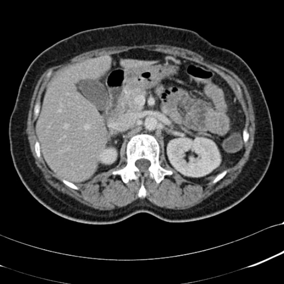 File:Acute appendicitis (Radiopaedia 48792-53822 Axial C+ portal venous phase 37).jpg