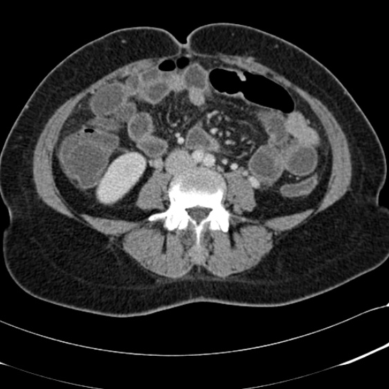 Acute appendicitis (Radiopaedia 48792-53822 Axial C+ portal venous phase 66).jpg