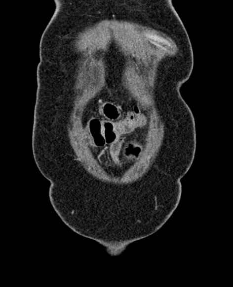 File:Acute appendicitis (Radiopaedia 48792-53822 Coronal C+ portal venous phase 27).jpg