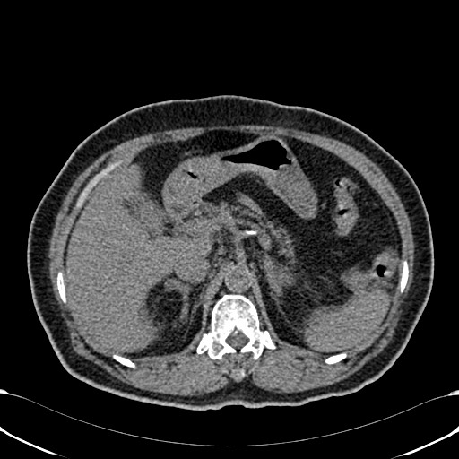 Acute appendicitis (Radiopaedia 58627-65818 Axial non-contrast 26).jpg