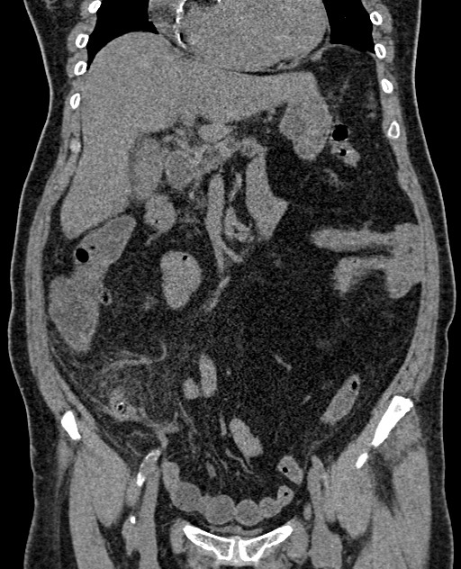 Acute appendicitis (Radiopaedia 58627-65818 Coronal non-contrast 35).jpg
