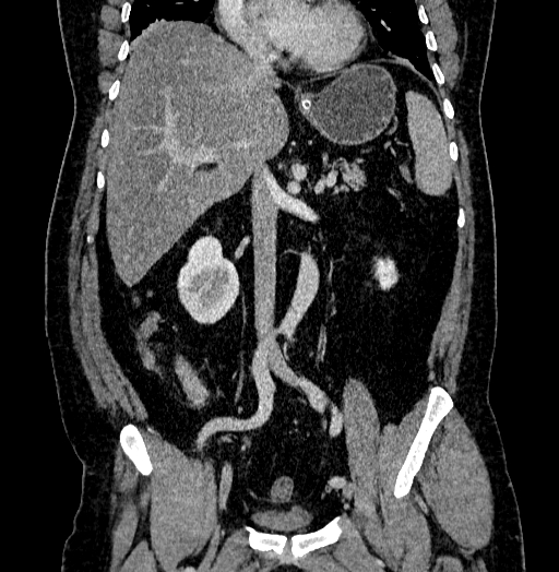 Acute appendicitis (Radiopaedia 79950-93224 Coronal C+ portal venous phase 47).jpg