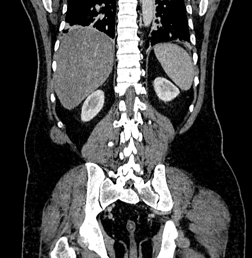 Acute appendicitis (Radiopaedia 79950-93224 Coronal C+ portal venous phase 71).jpg
