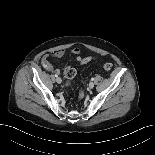 Acute appendicitis - large appendicoliths (Radiopaedia 61805-69820 Axial C+ portal venous phase 104).jpg