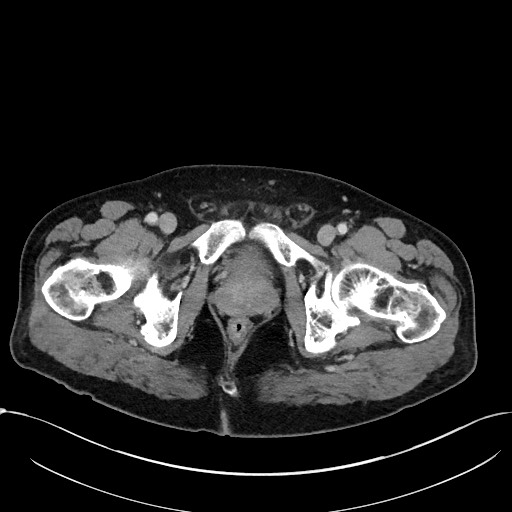 Acute appendicitis - large appendicoliths (Radiopaedia 61805-69820 Axial C+ portal venous phase 131).jpg