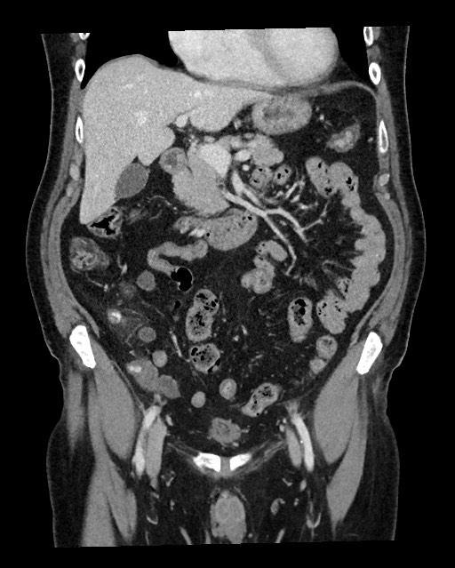 Acute appendicitis - large appendicoliths (Radiopaedia 61805-69820 Coronal C+ portal venous phase 53).jpg