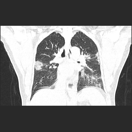 File:Acute appendicitis and COVID 19 pneumonia (Radiopaedia 76604-88380 G 37).jpg