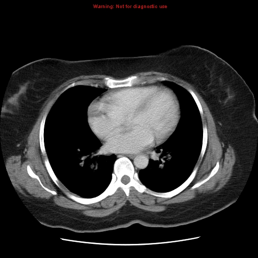 File:Acute appendicitis complicated by ovarian vein thrombophlebitis (Radiopaedia 16172-15851 Axial C+ portal venous phase 5).jpg