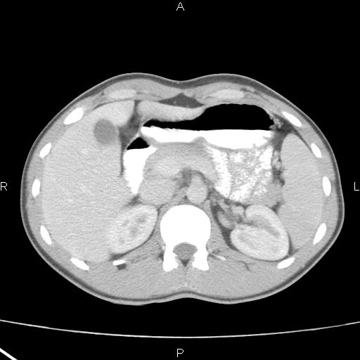 File:Acute appendicitis with CT arrowhead sign (Radiopaedia 21474-21411 Axial C+ portal venous phase 11).jpg