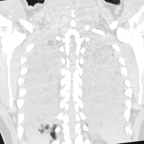 Acute aspiration pneumonitis (Radiopaedia 33605-34703 Coronal lung window 64).jpg