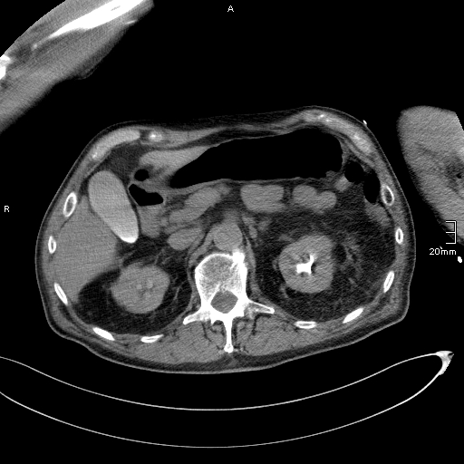 Acute aspiration pneumonitis (Radiopaedia 55642-62166 Axial liver window 66).jpg